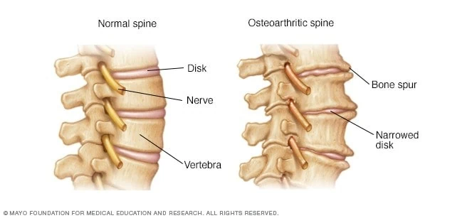 Normal Spine vs. Osteoarthritic Spine