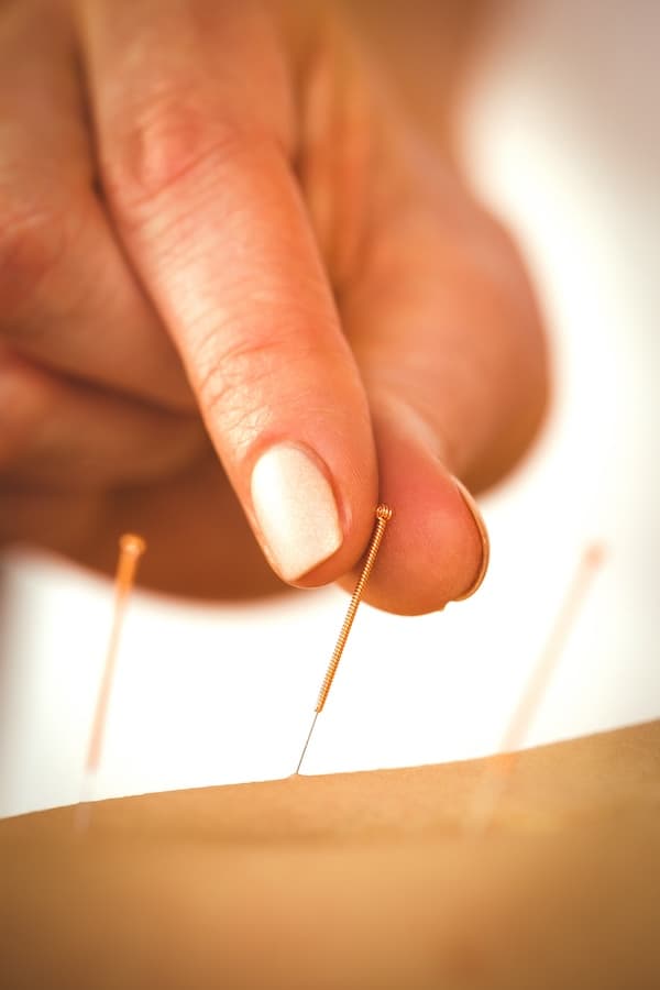 young woman getting acupuncture treatment in thera 2021 08 28 16 11 06 utc 2
